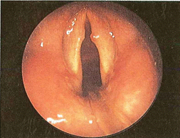 Figura 10 - macroscopiche patologie nodulari