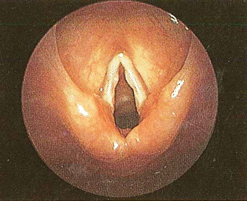 Figura 14 - macroscopiche patologie nodulari